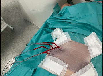 Prowadnica przymocowana na plecach pacjenta leżącego na brzuchu, przez kanały wprowadzone kriosondy