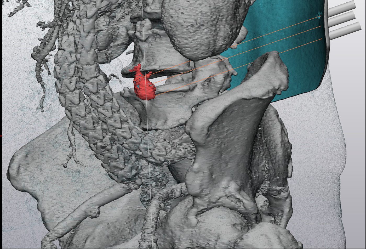 Model 3D kości miednicy, kręgosłupa i stent-graftu z zaplanowaną prowadnicą na plecach i trajektoriami prowadzącymi do worka tętniaka