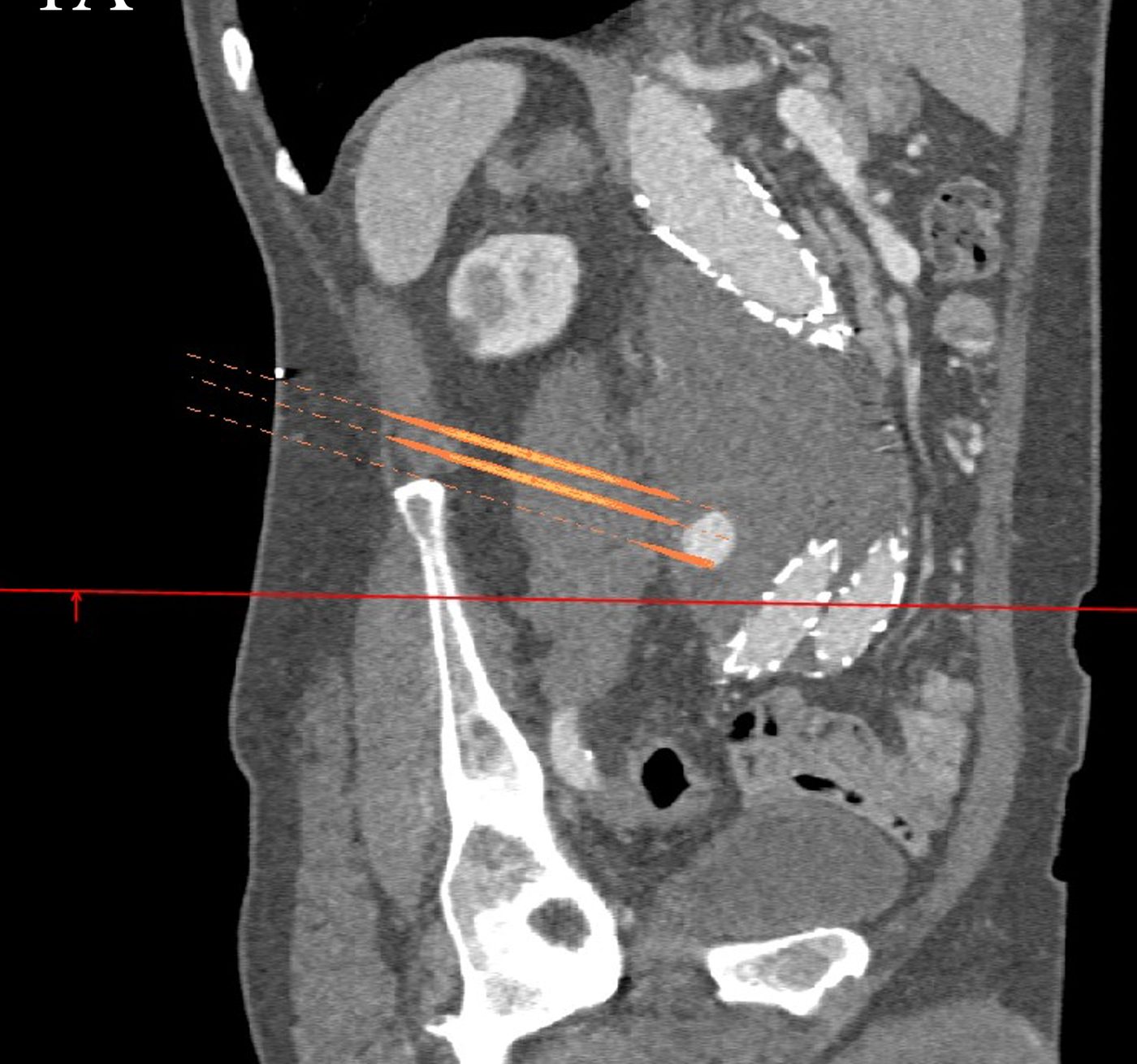 Przekrój strzałkowy tomografii komputerowej z narysowanymi trajektoriami igły od skóry pleców do worka tętniaka