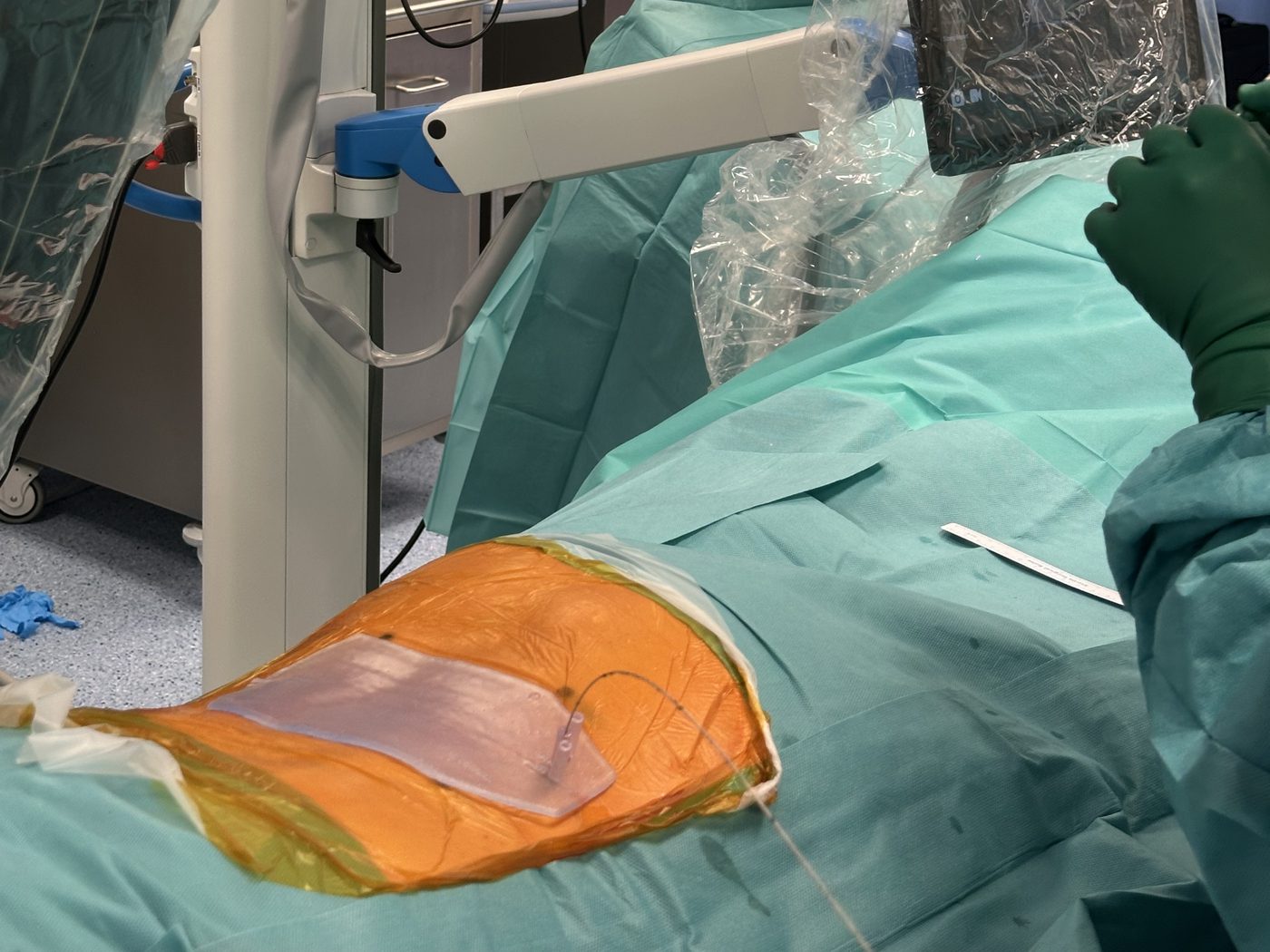 Prowadnica na plecach pacjenta z prowadnikiem wprowadzonym przez kanał, obok ramię i panel sterowania angiografu
